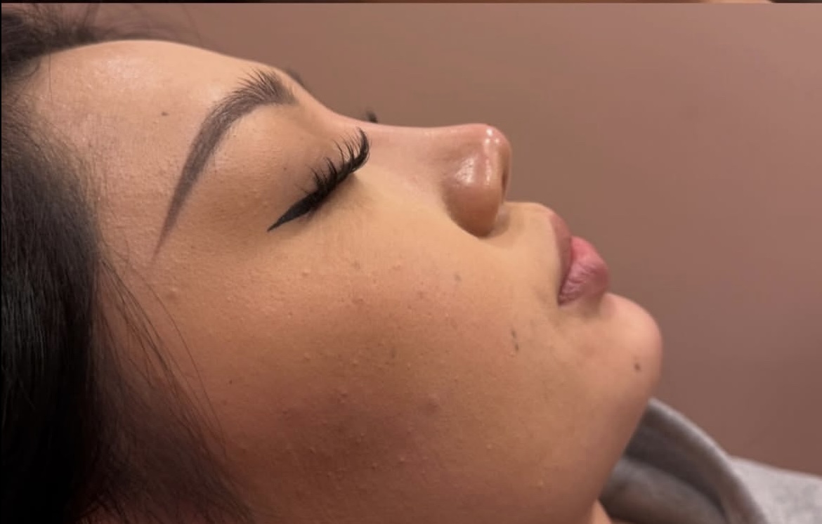 Chin filler after treatment